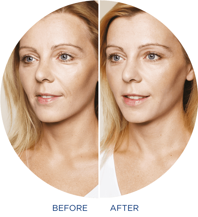 Botox moet je niet zien.