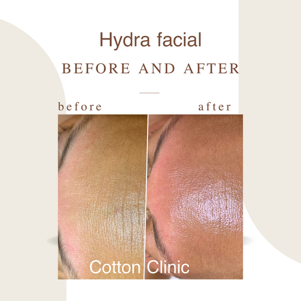 Hydra facial deal 5x